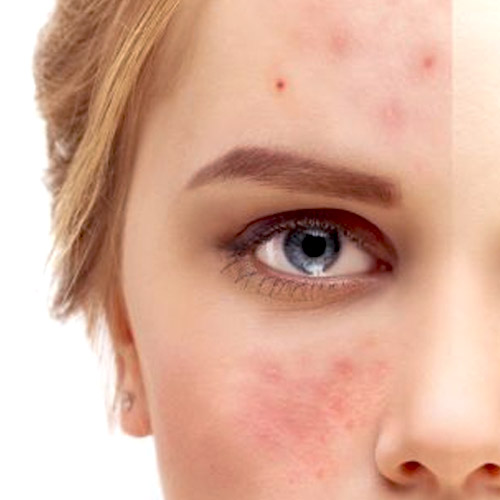 TÉCNICA TRATA CÂNCER DE PELE NO ROSTO PRESERVANDO OS TECIDOS 2